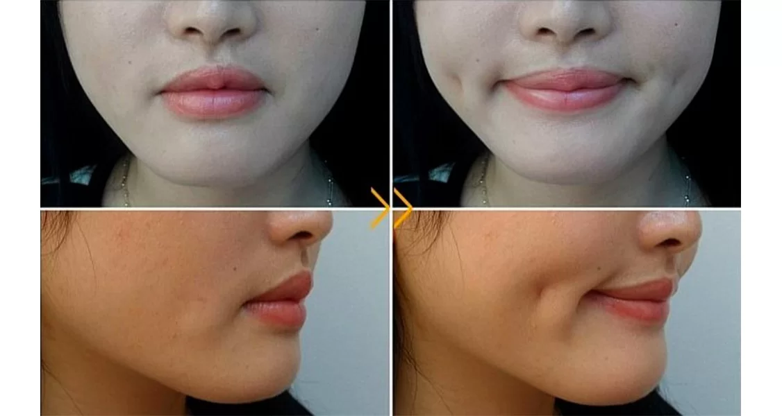 Димплэктомия для создания ямочек на щеках: полное руководство хирурга