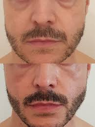 Хирургическая маскулинизация лица: обретение мужественных черт навсегда