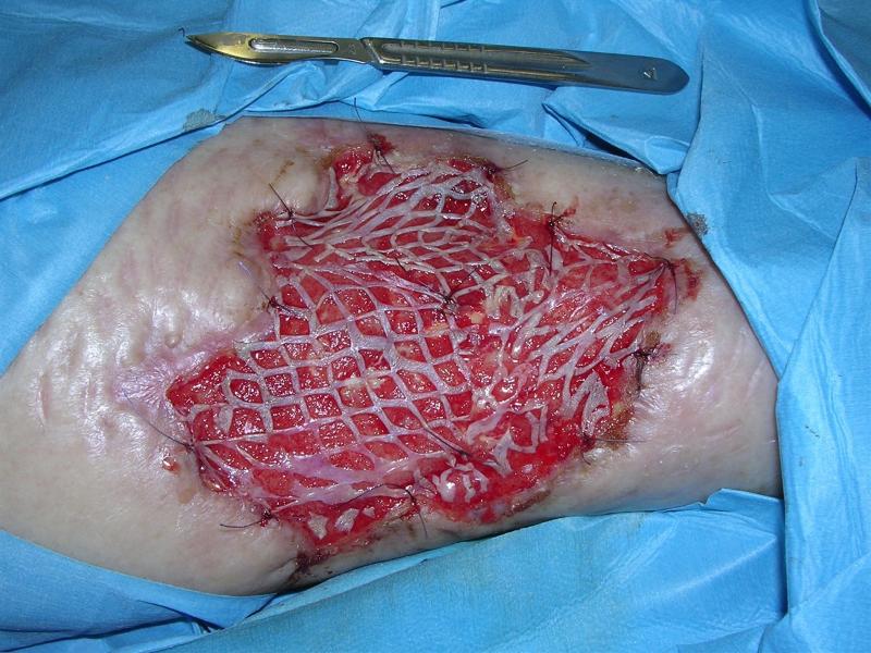 Кожная пластика: полное руководство по видам, показаниям и восстановлению