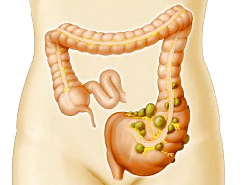 Дивертикулит кишечника: полное руководство по лечению и профилактике
