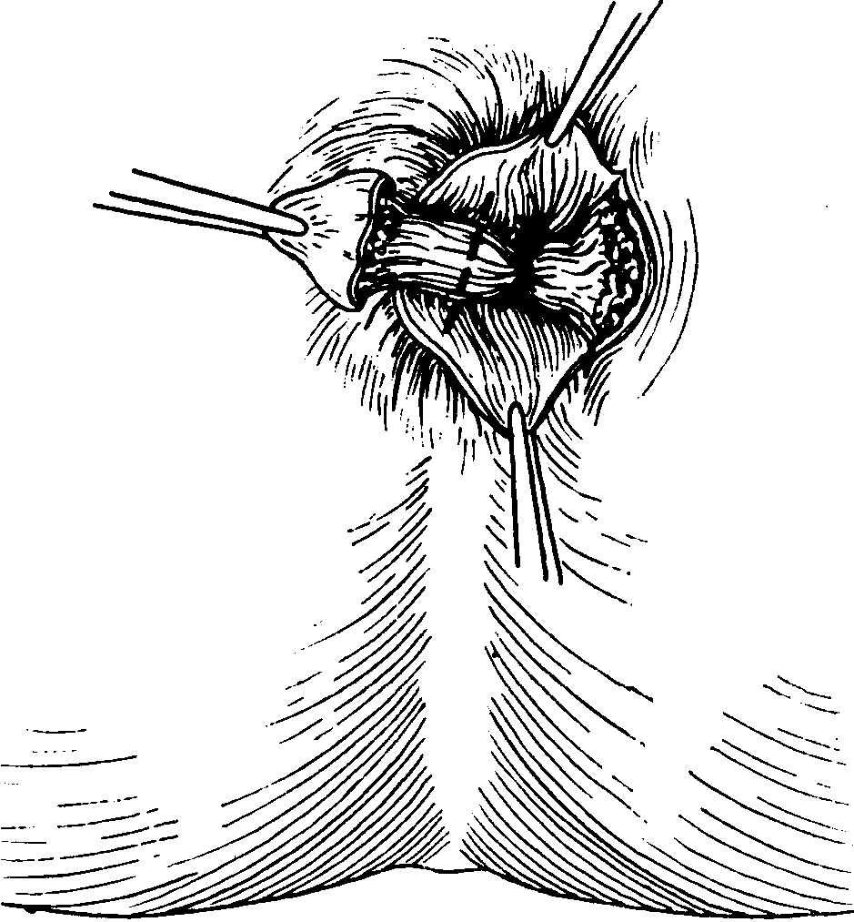 Пектеноз анального канала: полное руководство по причинам и лечению спазма