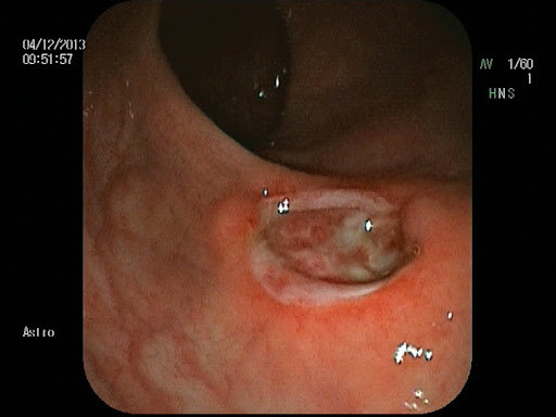 Солитарная язва прямой кишки: найти причину и выбрать верное лечение