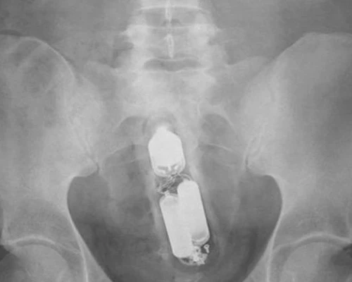 Инородное тело в прямой кишке: полное руководство по симптомам и лечению