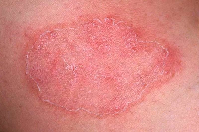 Перианальный дерматит: полное руководство по причинам и лечению у проктолога