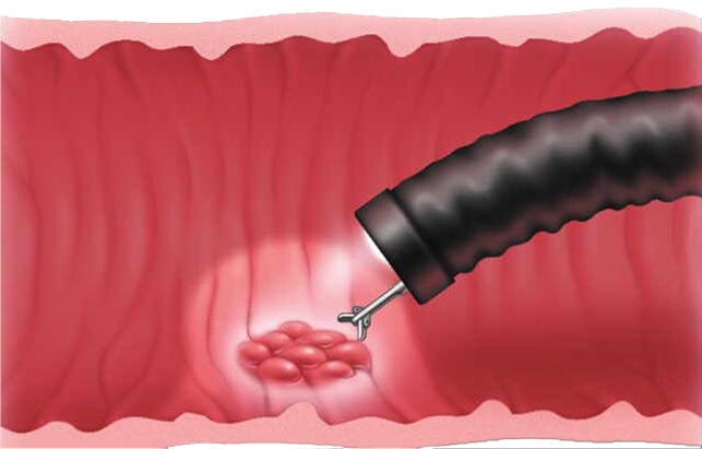Биопсия прямой кишки: полное руководство по процедуре и ее результатам