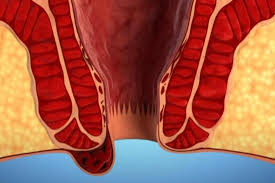 Сфинктеропластика: полное руководство по восстановлению функции сфинктера
