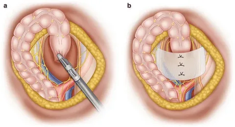 Ректопексия: возвращение комфорта и уверенности при выпадении прямой кишки