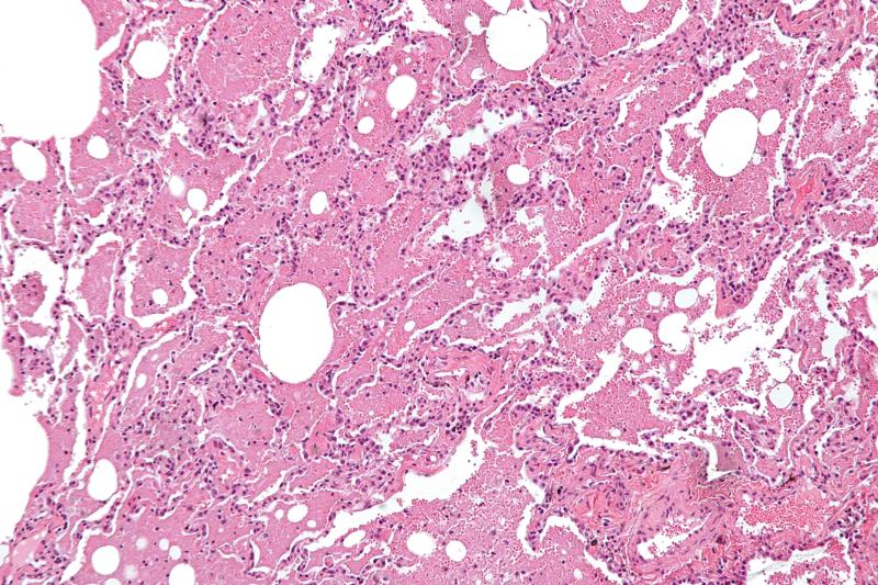 Альвеолярный протеиноз легких: обретение контроля над редким заболеванием