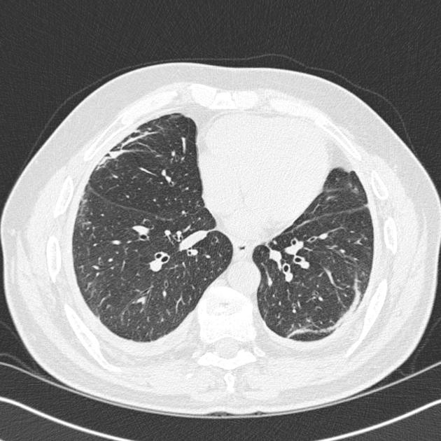 Асбестоз легких: найти причину, остановить развитие и улучшить дыхание