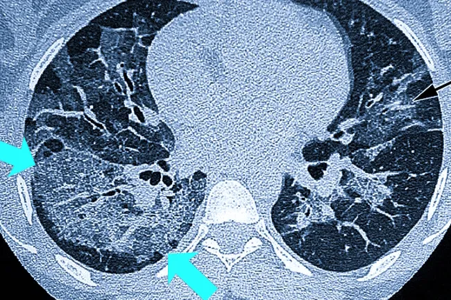 Десквамативная интерстициальная пневмония (ДИП): полный гайд по диагнозу и лечению
