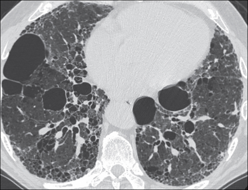 Идиопатический легочный фиброз (ИЛФ): обретение контроля над заболеванием легких