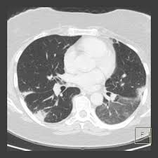 Криптогенная организующаяся пневмония (КОП): обрести контроль над заболеванием