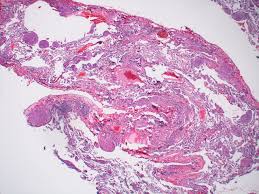 Лимфангиолейомиоматоз (ЛАМ): полный гид по редкой патологии легких