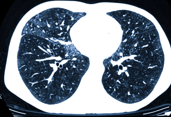 Лимфоидная интерстициальная пневмония (ЛИП): обрести контроль над дыханием