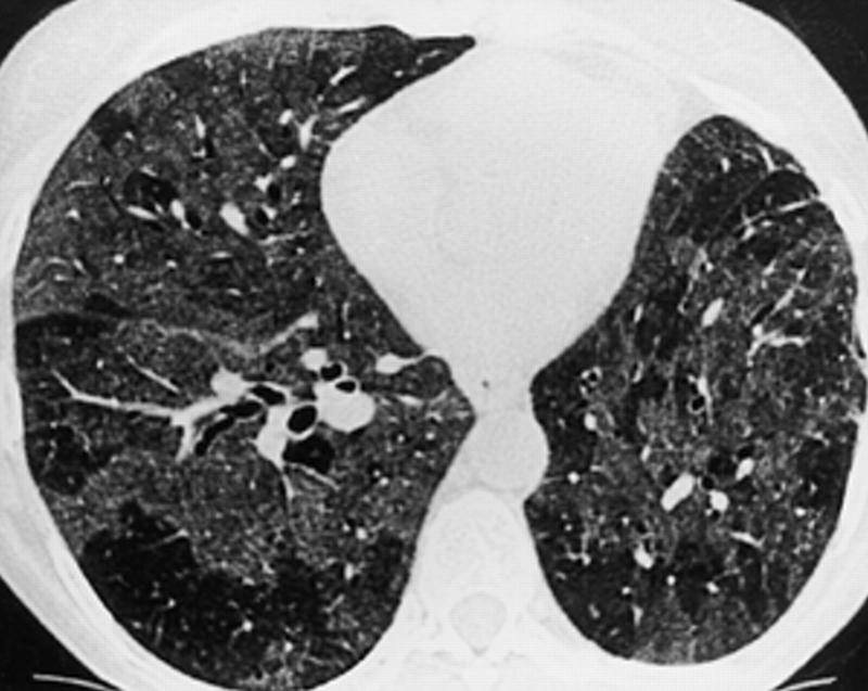 Облитерирующий бронхиолит: полное руководство по диагностике и лечению