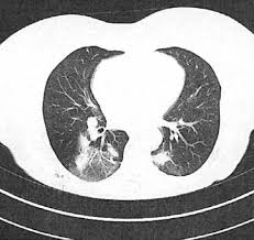 Острая эозинофильная пневмония (ОЭП): полное руководство по диагностике и лечению