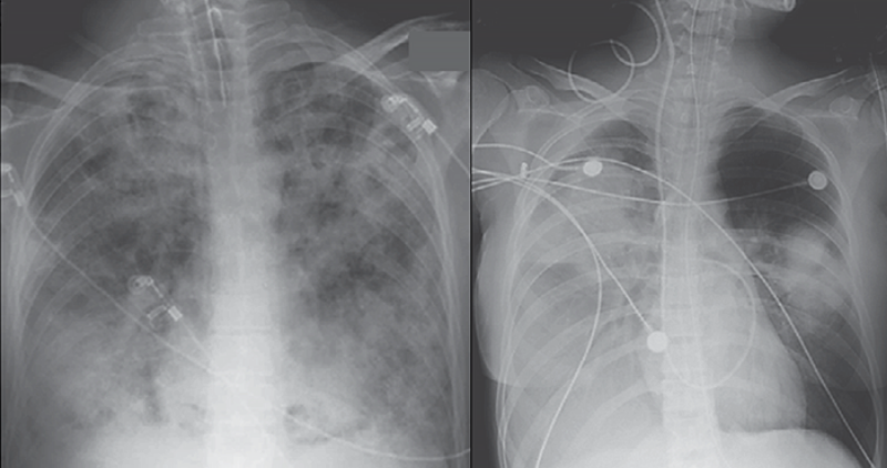 Острый респираторный дистресс-синдром (ОРДС): что это и как спасают легкие