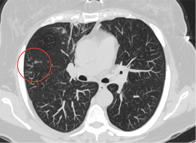 Респираторный бронхиолит с интерстициальным заболеванием легких (РБ-ИЗЛ): полное руководство