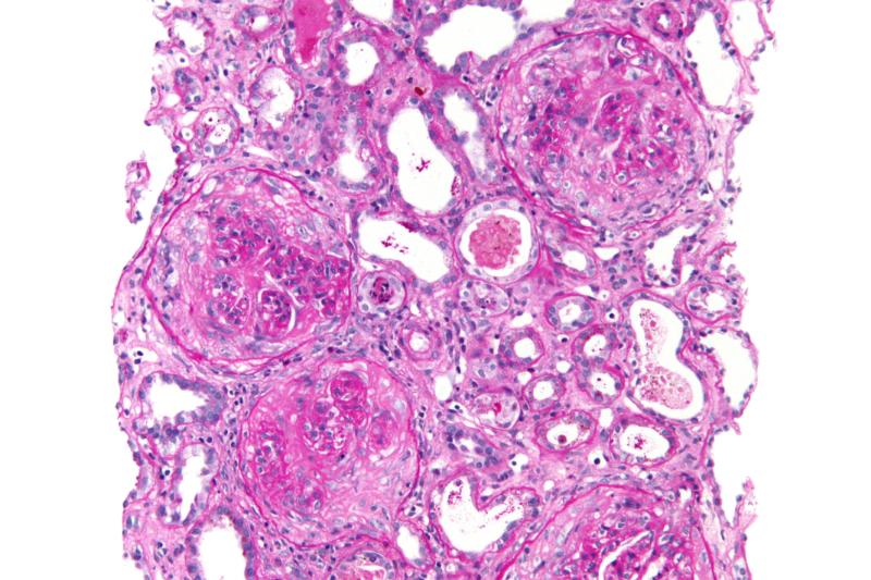 Синдром гудпасчера (СГП): полное руководство по диагностике, лечению и прогнозу
