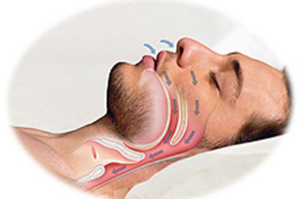 Синдром обструктивного апноэ сна: полное руководство по распознаванию и лечению