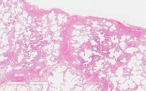 Экзогенный аллергический альвеолит (ЭАА): причины, симптомы и современное лечение