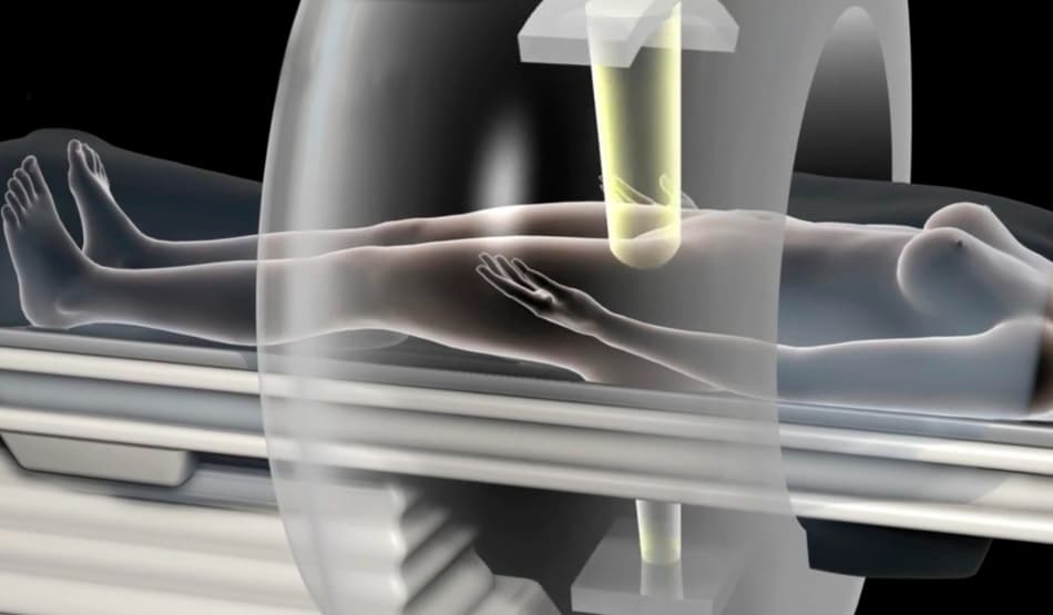 Радиотерапия рака шейки матки: как лечение помогает достичь выздоровления и справиться с болезнью