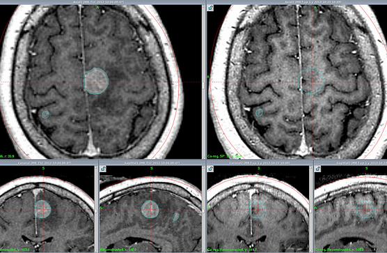 Радиотерапия метастазов в головной мозг: полное руководство по лечению