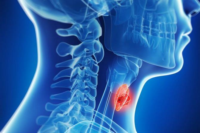 Радиотерапия рака щитовидной железы: полное руководство по лечению