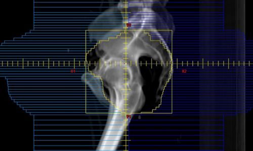 Интенсивно-модулированная лучевая терапия (IMRT): полное руководство по методу