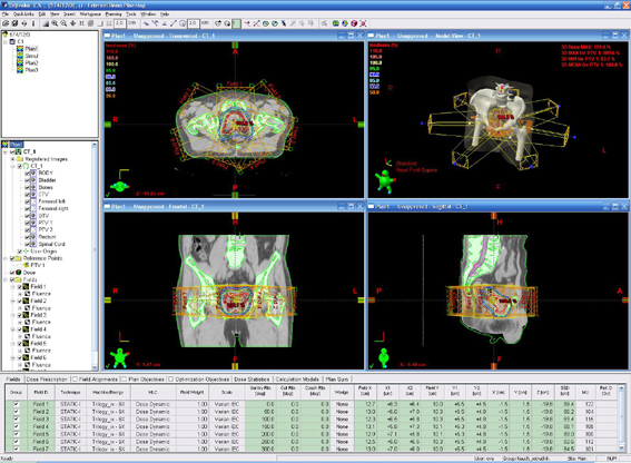 Планирование лучевой терапии: создание индивидуального и точного плана лечения