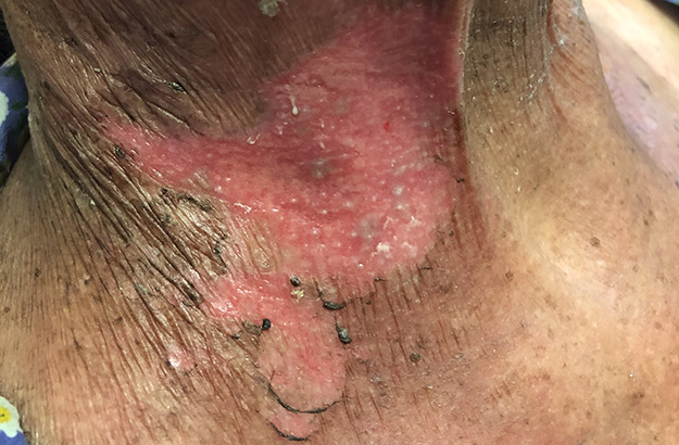 Поздние лучевые осложнения после радиотерапии: полное руководство по диагностике, профилактике и лечению