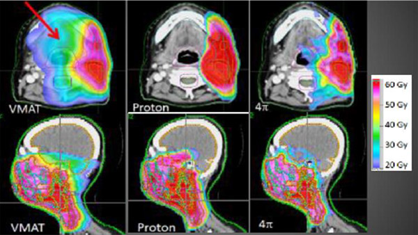 Срочная радиотерапия при жизнеугрожающих состояниях: что нужно знать