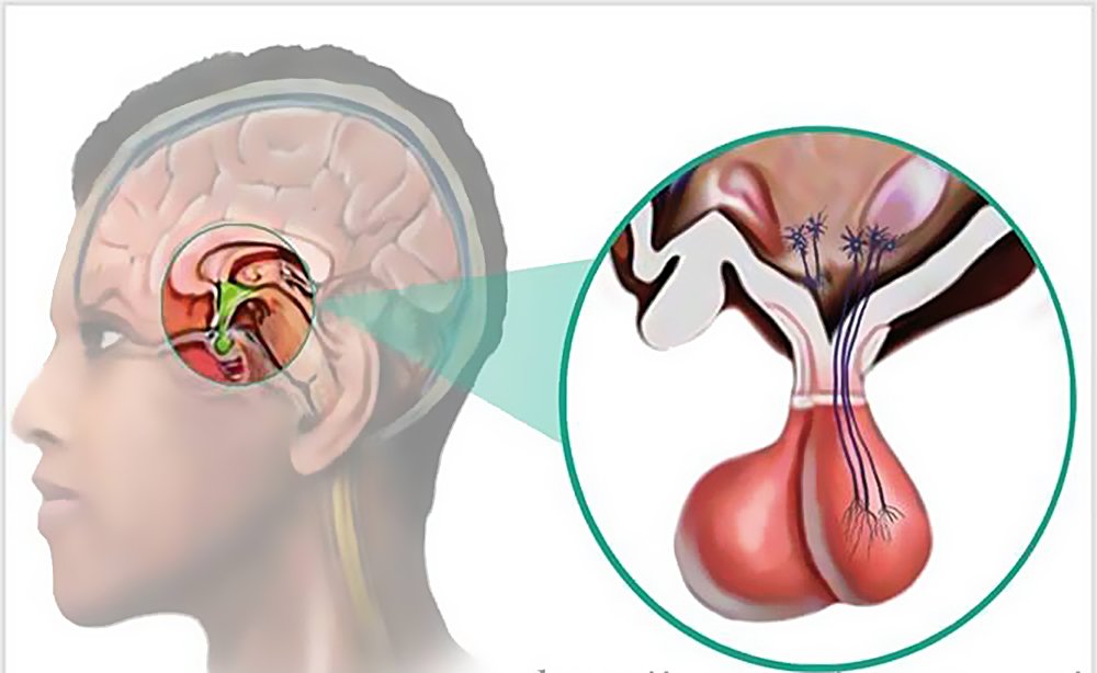 Лучевая терапия опухолей гипофиза: полное руководство для пациентов