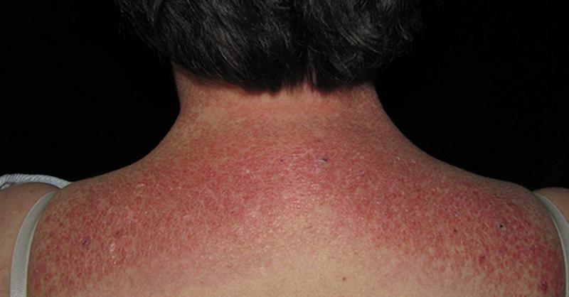 Дерматомиозит: полное руководство по диагностике, лечению и жизни с болезнью