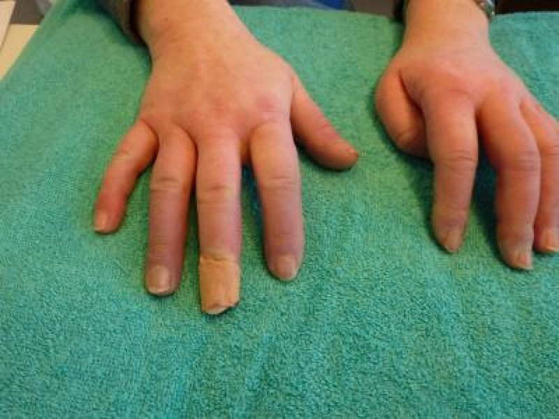 Смешанное заболевание соединительной ткани (синдром шарпа): полное руководство