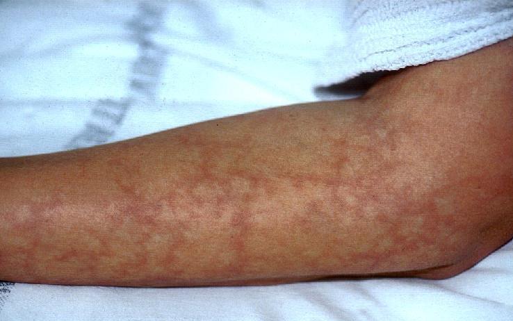 Антифосфолипидный синдром: полное руководство по диагностике и лечению