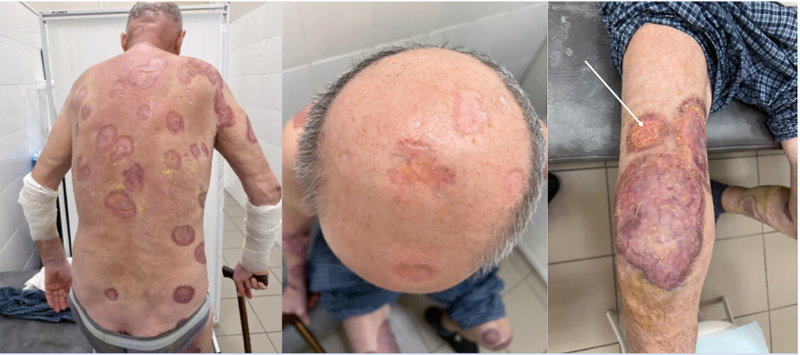 Гранулематоз с полиангиитом (ГПА): полное руководство по болезни вегенера