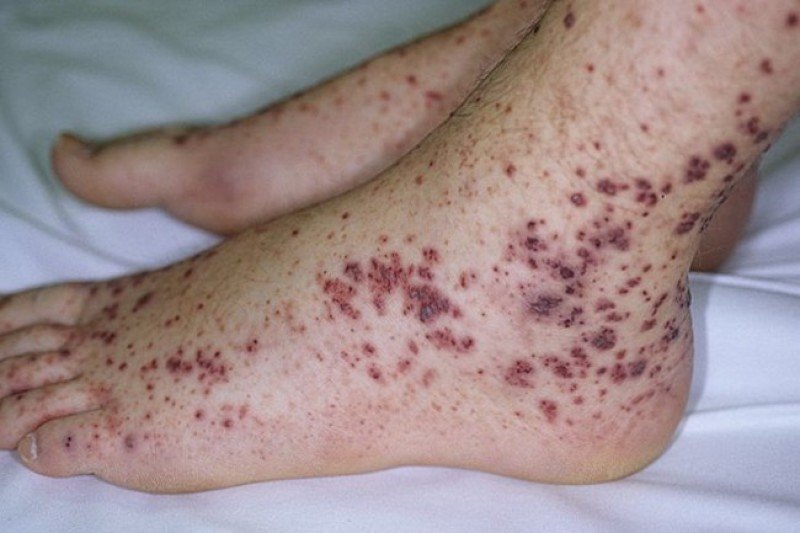 Микроскопический полиангиит (МПА): полное руководство по причинам, симптомам, диагностике и лечению