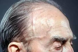 Гигантоклеточный артериит (ГКА): полное руководство по диагностике и лечению