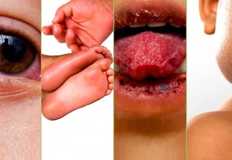 Болезнь кавасаки: полное руководство по диагностике, лечению и прогнозу у детей