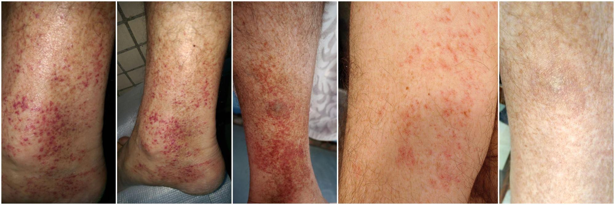 Криоглобулинемический васкулит (КГВ): полное руководство по распознаванию и лечению