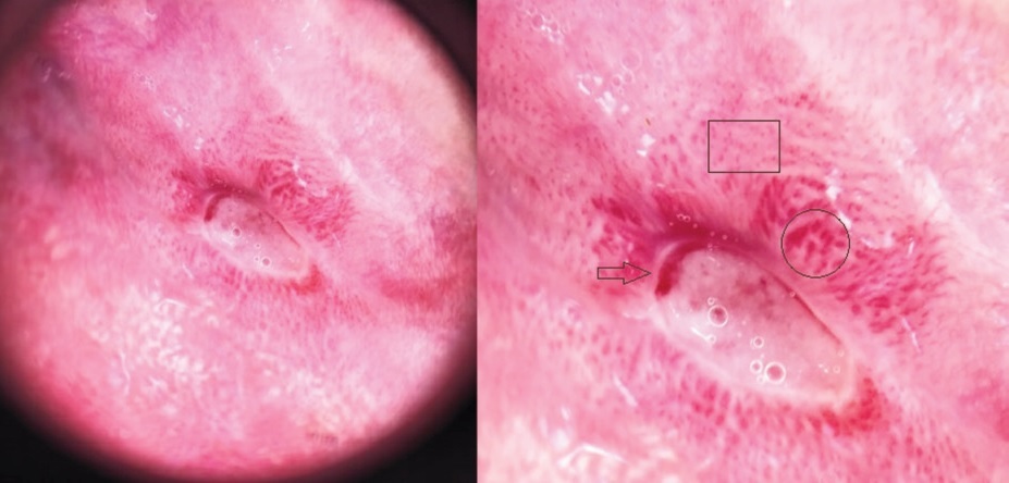 Болезнь бехчета: симптомы, диагностика и эффективное лечение васкулита