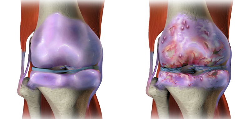 Септический артрит (СА): полное руководство по инфекционному воспалению суставов
