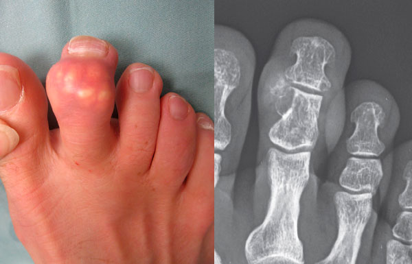 Псевдоподагра: что это, причины развития и как справиться с болезнью