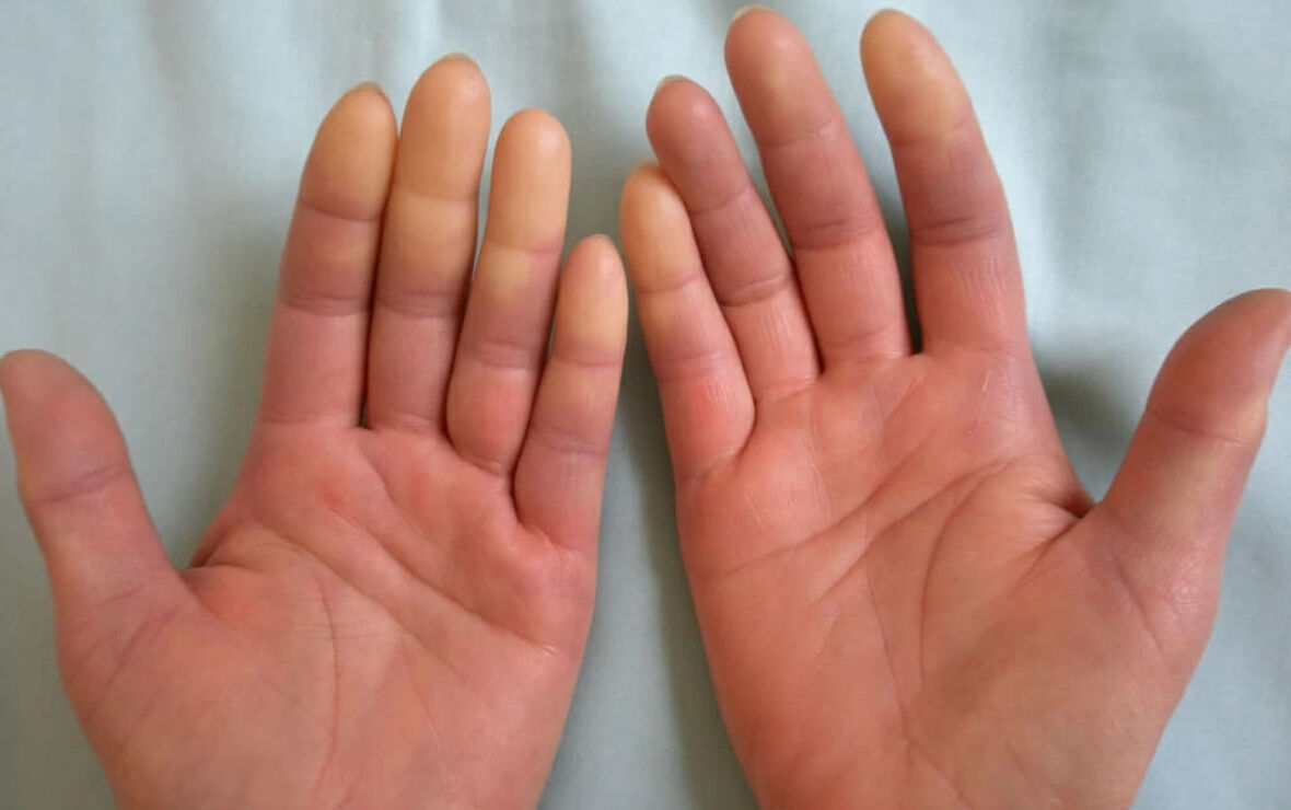 Феномен рейно: полное руководство по причинам, симптомам и эффективному лечению