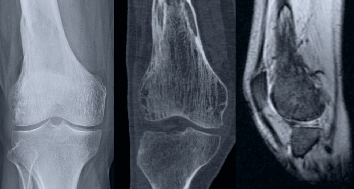 Как жить с болезнью педжета (деформирующим остеитом): полное руководство