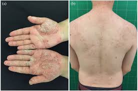 SAPHO-синдром: что это, симптомы, диагностика и современные подходы к лечению