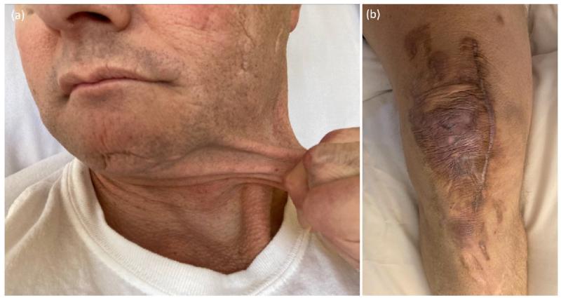 Синдром элерса-данлоса (СЭД): полное руководство по жизни с гипермобильностью и хронической болью