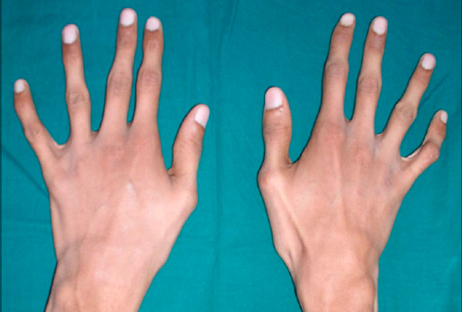 Синдром марфана: полное руководство по диагностике, лечению и жизни с ним