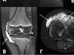 Пигментный виллонодулярный синовит (ПВНС): полное руководство по диагностике и лечению
